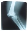 Glucosamine Sulfate Promotes Joint Health